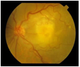 maculardegeneration_clip_image006